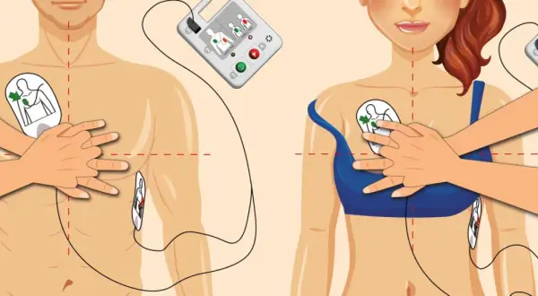 Instrukcja użycia AED: jak podłączyć elektrody do klatki piersiowej mężczyzny i kobiety, by ratować życie.