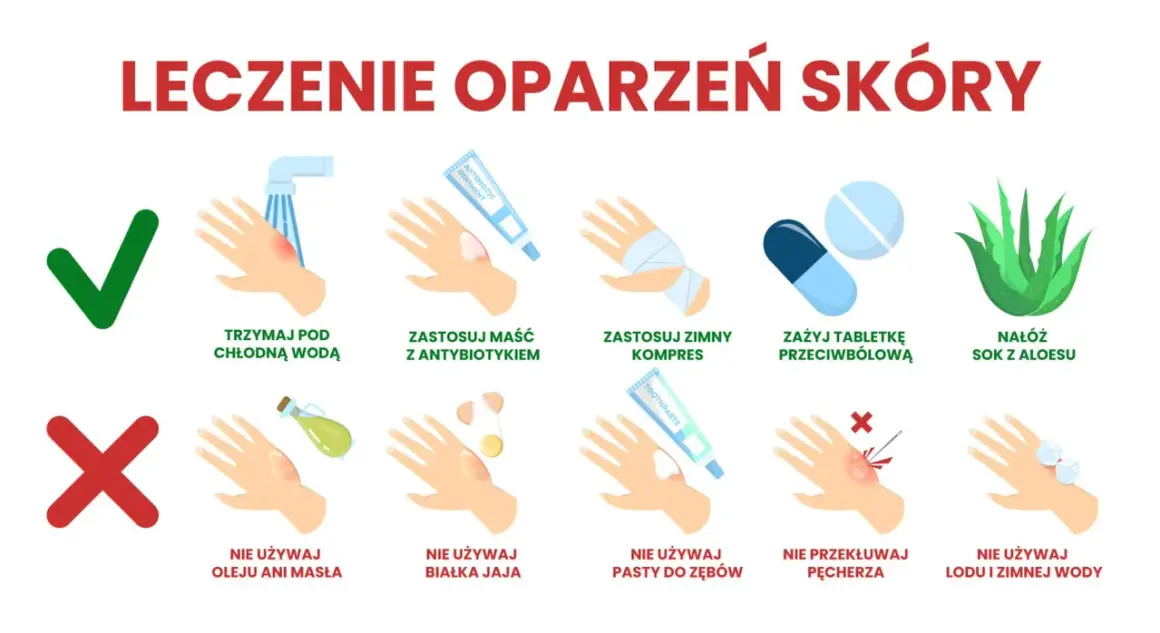 Ilustracja pokazuje, jak leczyć oparzenia skóry: chłodna woda, maść z antybiotykiem, zimny kompres, tabletki przeciwbólowe i aloes są zalecane. Unikaj masła, jajka, pasty do zębów, przekłuwania pęcherzy i lodu.
