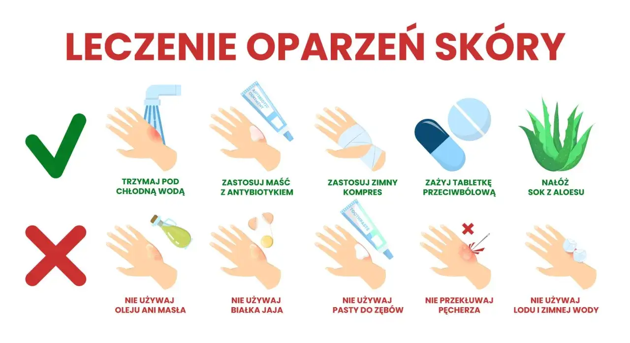 Ilustracja pokazuje leczenie oparzeń skóry: chłodna woda, maść z antybiotykiem, zimny kompres, tabletki przeciwbólowe, sok z aloesu. Unikaj masła, jajka, pasty do zębów, lodu.